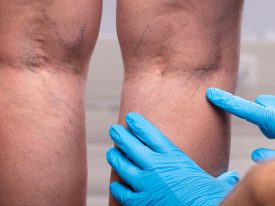 A Brief Overview of Spider Veins and Their Treatments